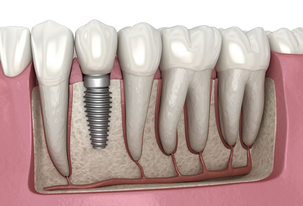 A Permanent Solution for Missing Teeth