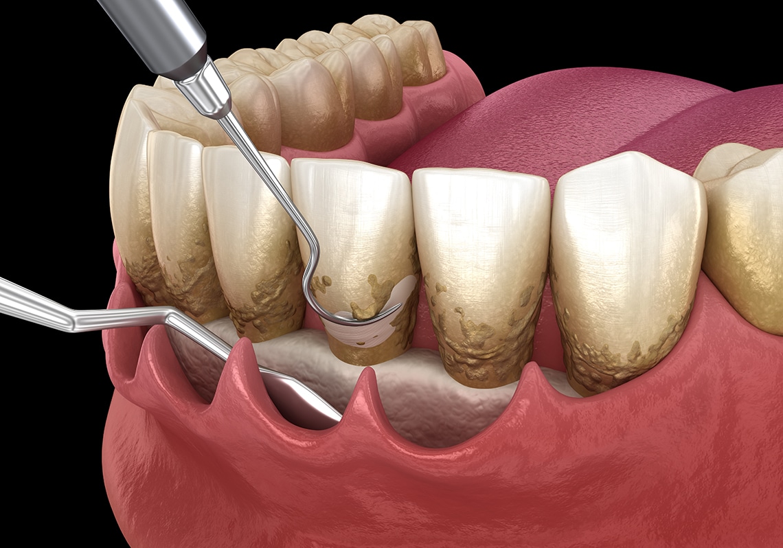 🪥 Gum Treatment (Periodontal Care)