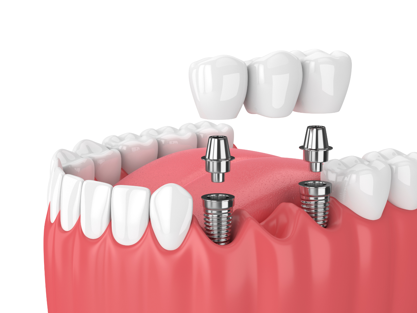 🦷 Dental Crowns & Bridges