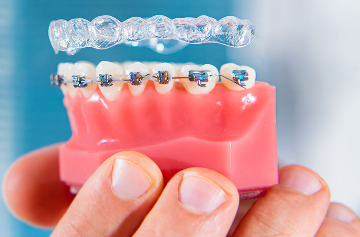 😬 Orthodontic Treatment (Braces & Aligners)